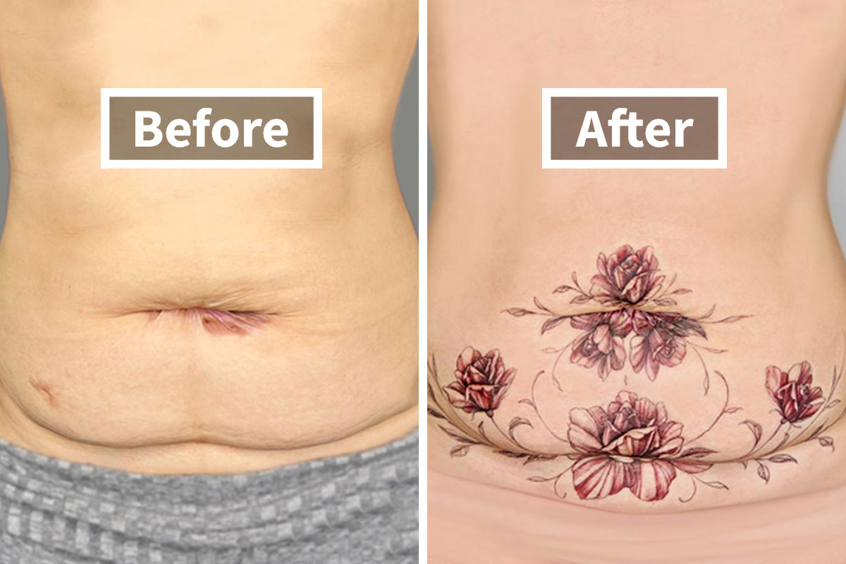 tummy tuck tattoo cover up before and after