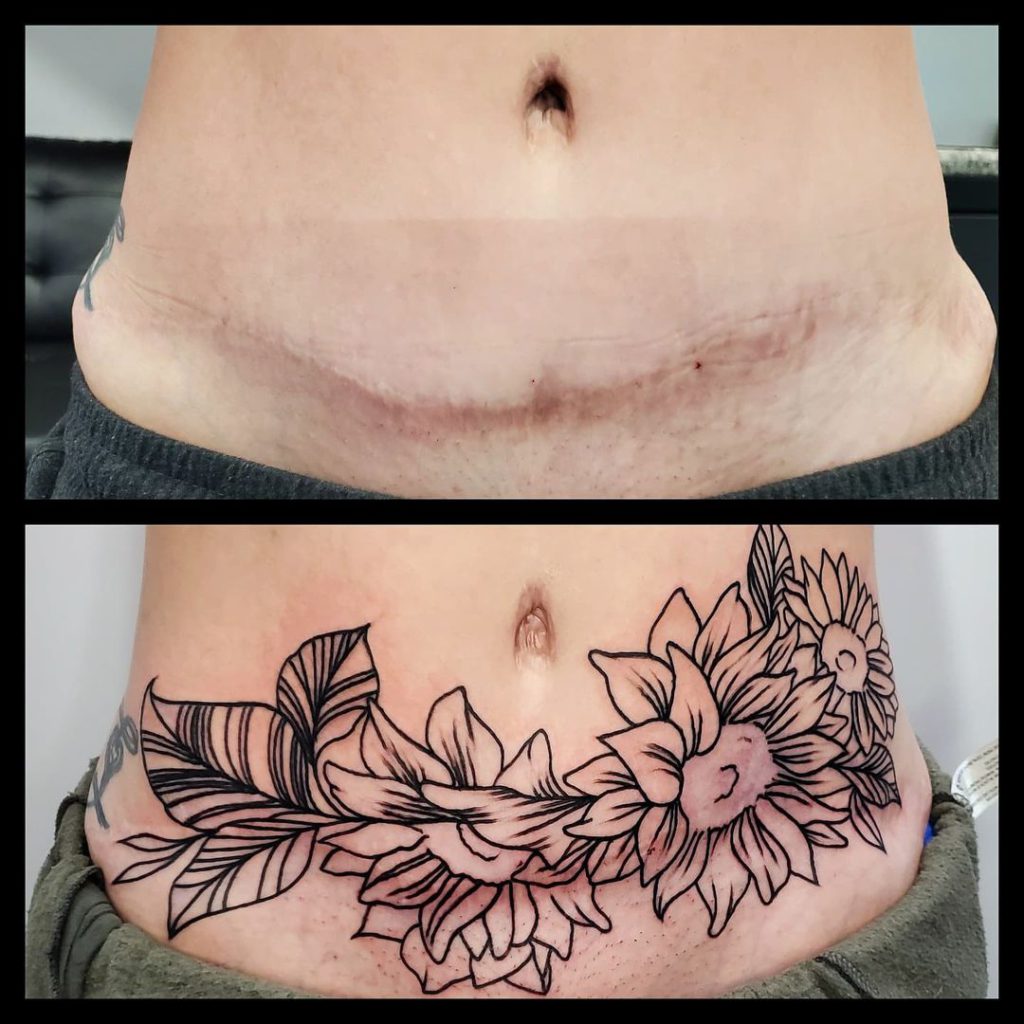 women's tummy tuck tattoo before and after