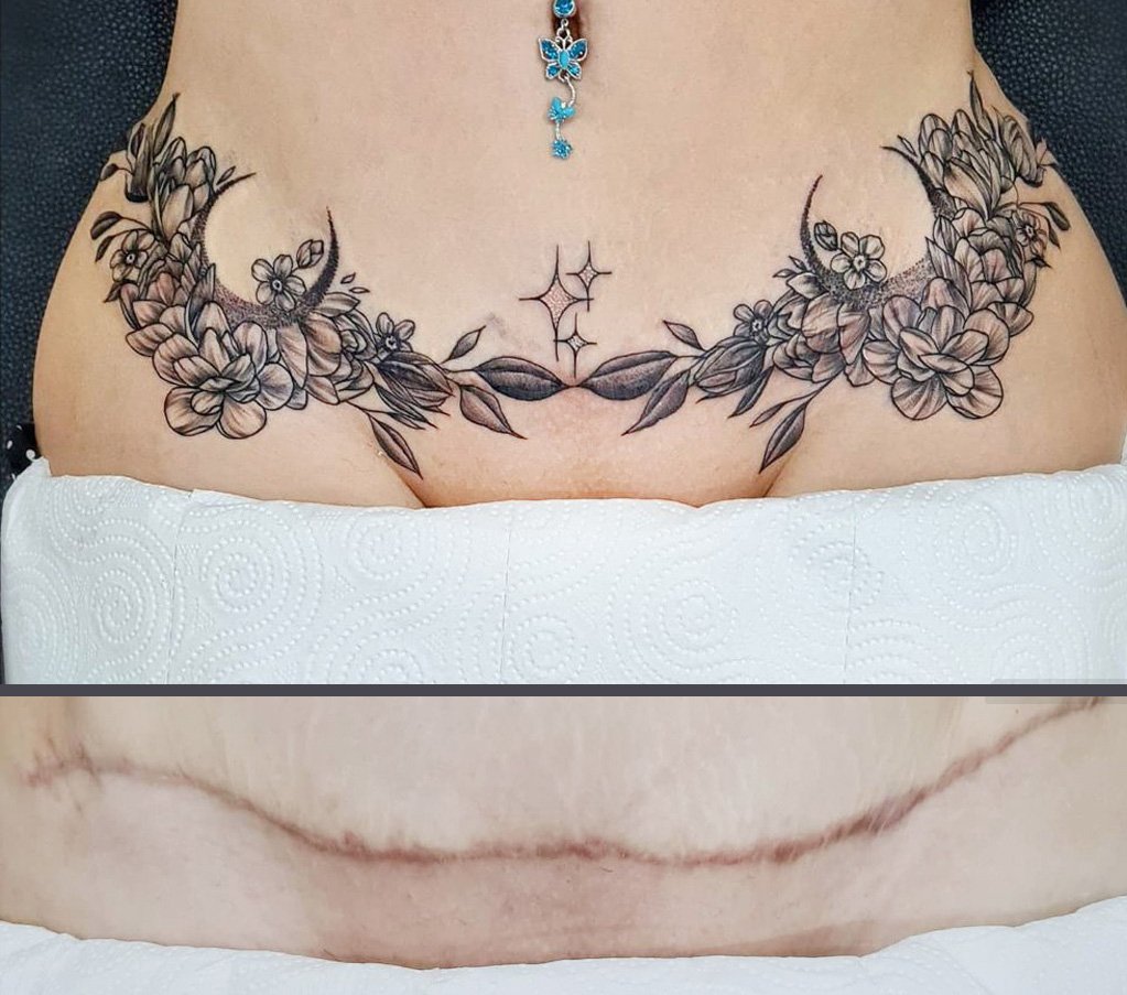 tummy tuck tattoos before and after