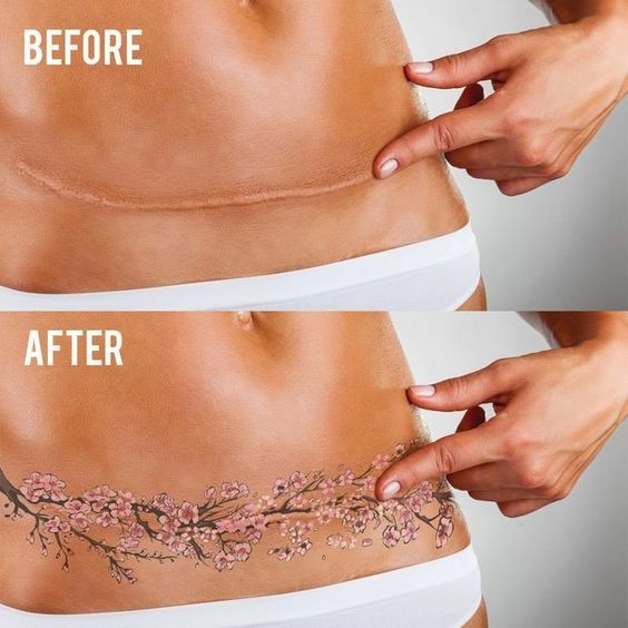 women's tummy tuck tattoo before and after
