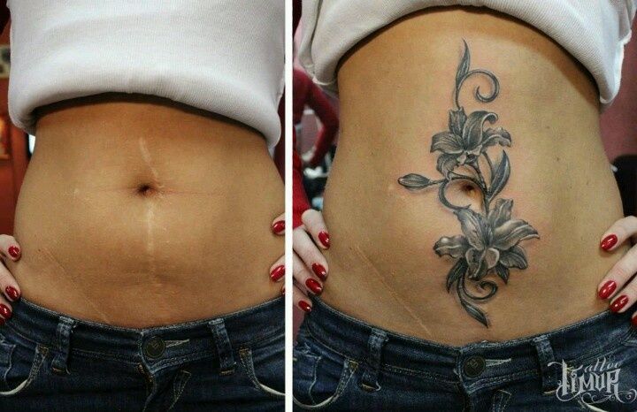 tummy tuck tattoos vertical scars cover up